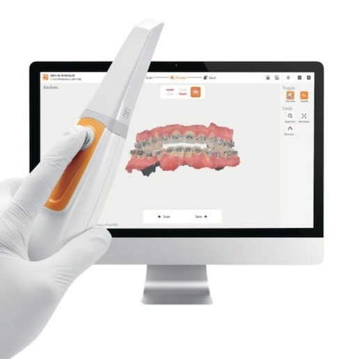 Imagen creada por el Scanner Intraoral
