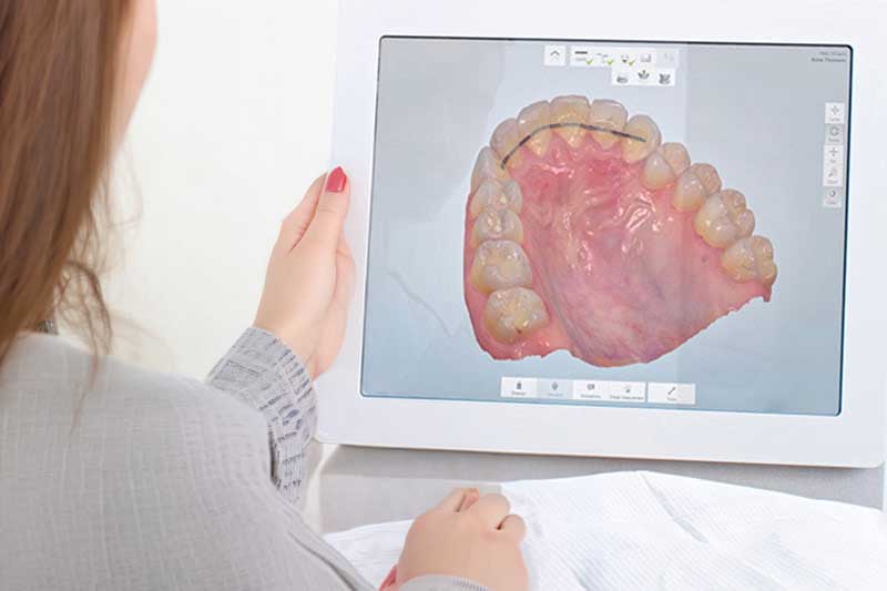 Scanner Intraoral