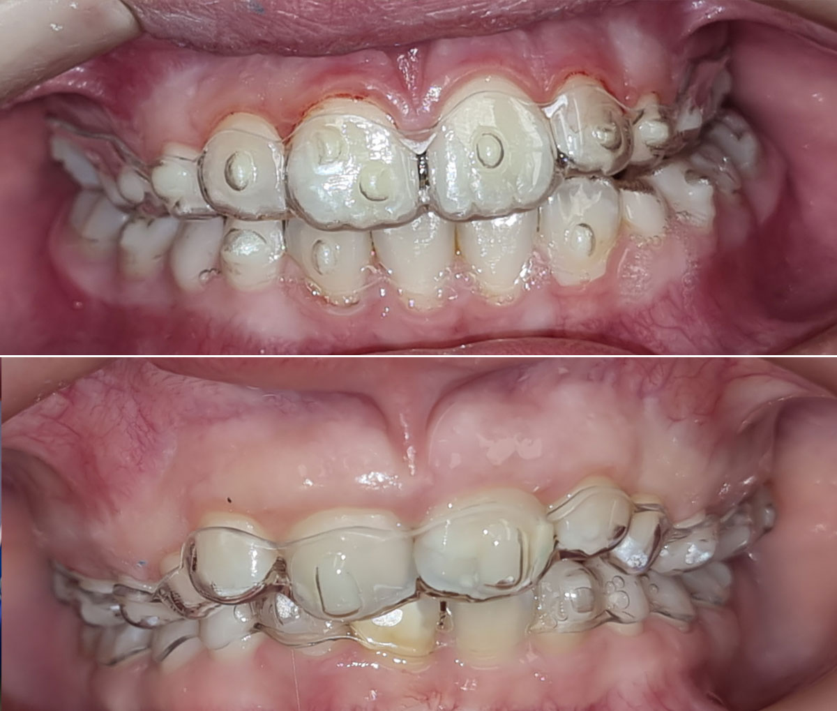 Alineadores dentales para niños Smartee